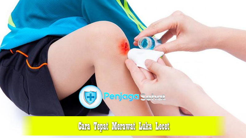 Cara Tepat Merawat Luka Lecet