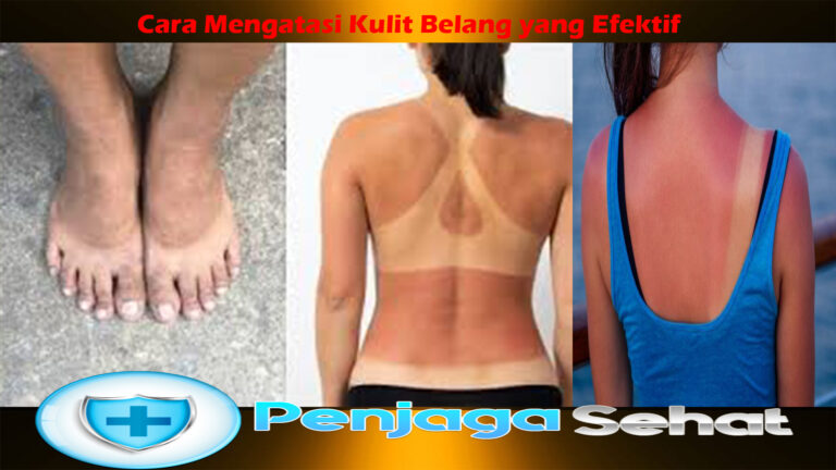 Cara Mengatasi Kulit Belang yang Efektif