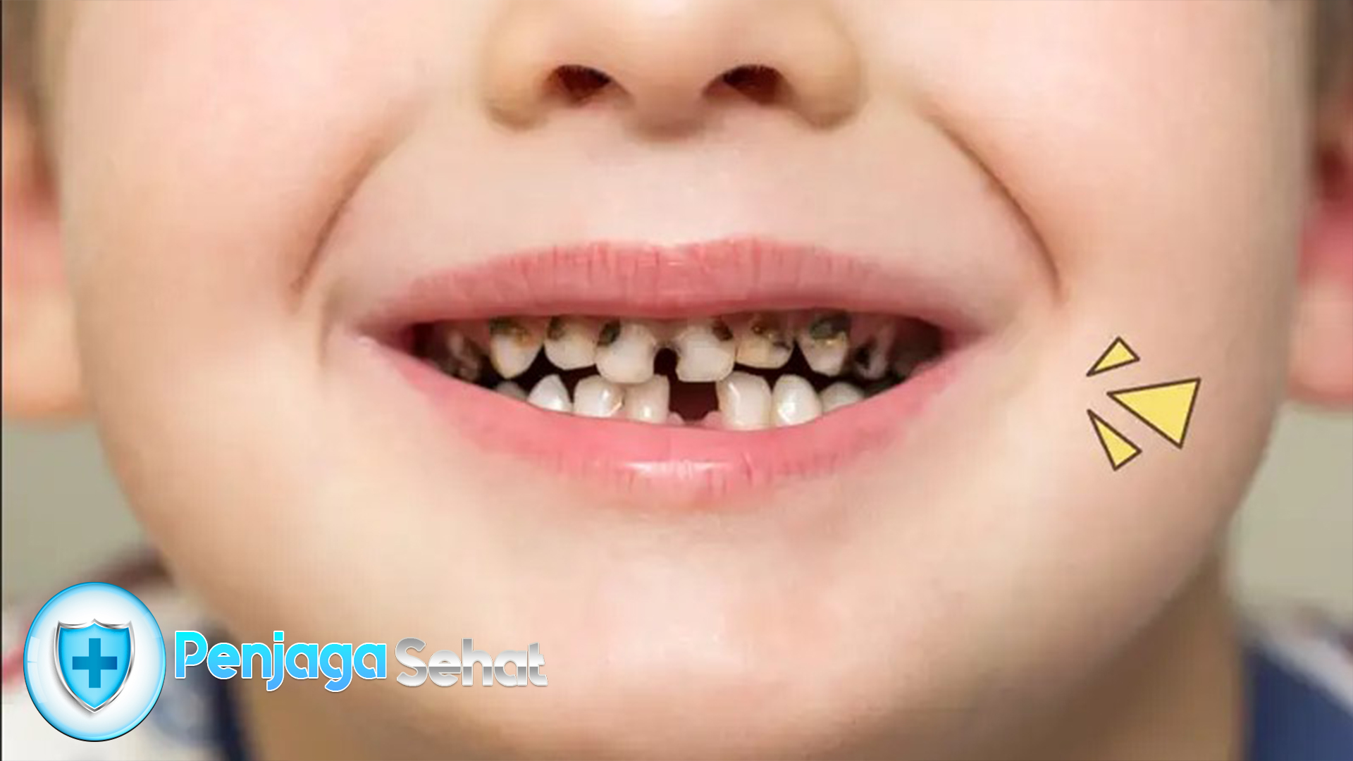 Kenali Penyebab Gigi Hitam dan Perawatannya