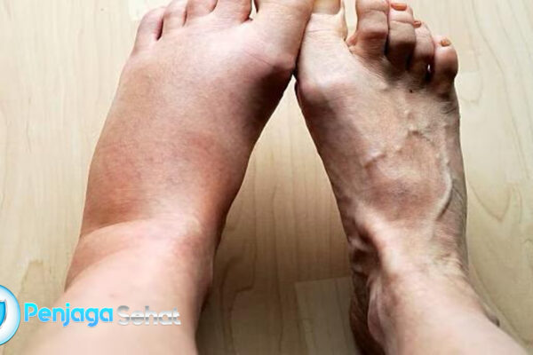 7 Obat Kaki Bengkak yang Ampu